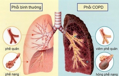 Chẩn đoán vi sinh vật gây bệnh viêm phổi, lao
